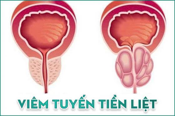 viem-tuyen-tien-liet.jpg