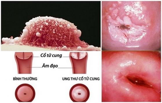 ung-thu-o-tu-cung_1.jpg