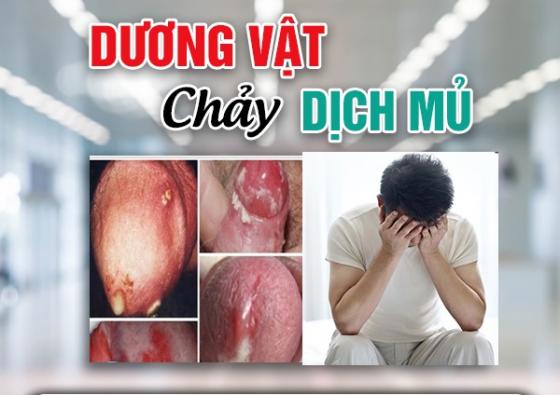 chay-dich-duong-vat.jpg