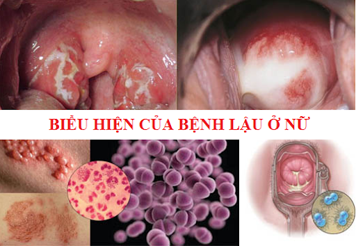 bệnh-lậu-ở-nữ-giới (1).png