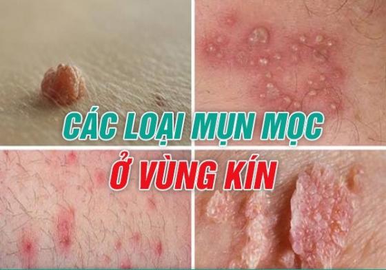 mun-vung-kin.jpg